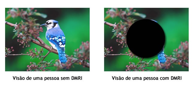 #DescriçãoDaImagem. Há duas fotos. A primeira mostra como é a visão de uma pessoa sem DMRI, a imagem está sem nenhuma alteração. A segunda foto simula a visão de uma pessoa com DMRI, a uma mancha escura no centro da imagem que impossibilita de ver o que está na região da mancha. As foto mostram um passarinho azul em cima de um galho.