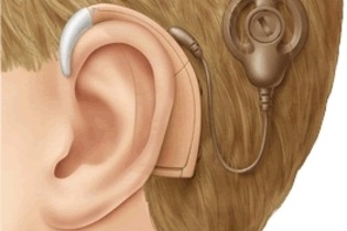 #PraCegoVer ilustração de um implante coclear