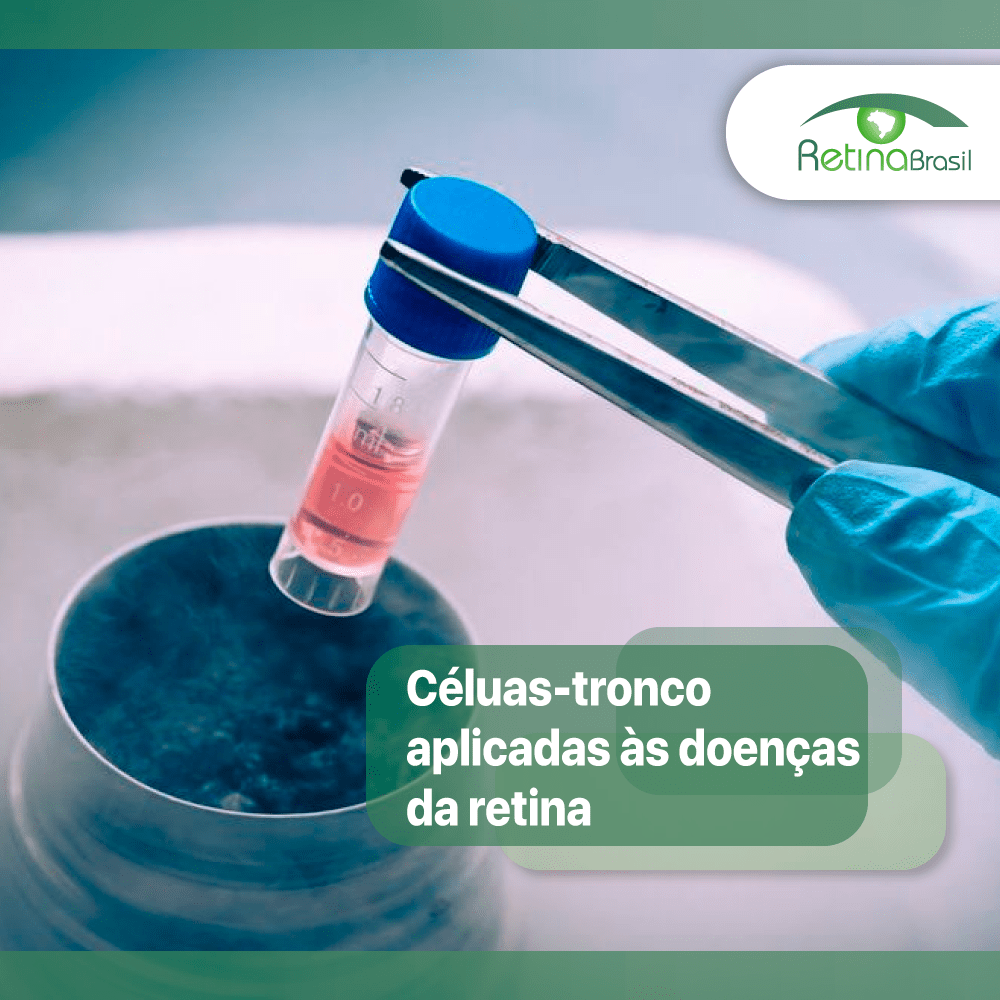 #PraCegoVer imagem de uma mão com luva azul clara pinçando um pequeno tubo de ensaio fechado que contém uma substância líquida alaranjada. Está escrito: "Células-tronco aplicadas às doenças da retina" e há a logo da Retina Brasil no canto superior direito.