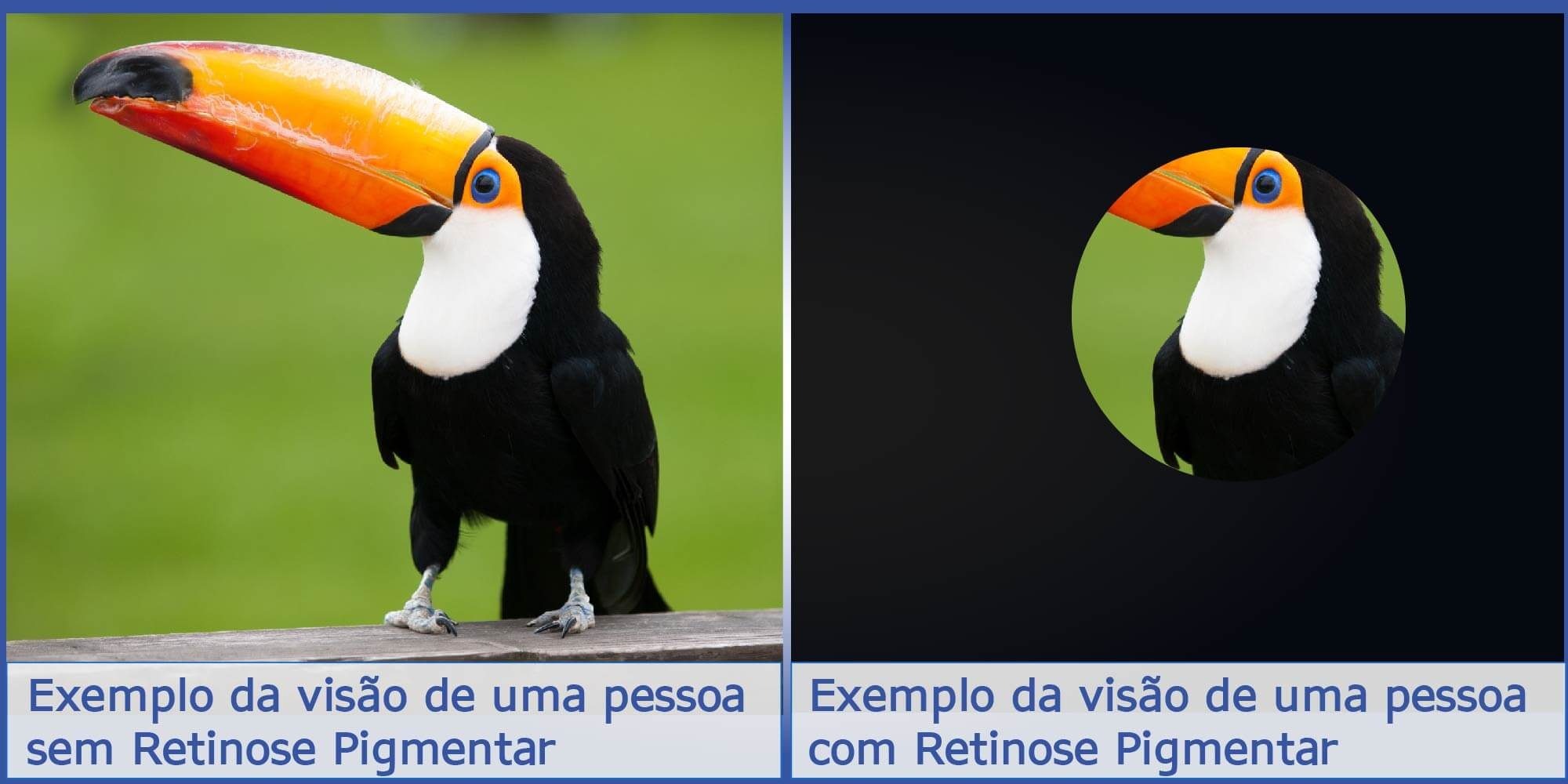 Imagem dividida ao meio. A primiera metade mostra o exemplo de visão de uma pessoa sem retinose, há a foto de um tucano. A segunda metada mostra um exmeplo de visão tubular, característica de uma pessoa com Retinose Pigmentar, nessa aprte vê-se apenas o olho e parte do corpo do tucano.